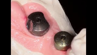 Healing Abutment is Stuck [upl. by Delfeena]