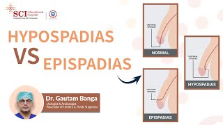 Hypospadias vs Epispadias  Dr Gautam Banga  SCI Hospital [upl. by Roland]