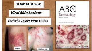 DERMATOLOGY Viral skin lesions  CHICKENPOX amp SHINGLES varicella zoster lesions derma viral [upl. by Hen]