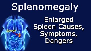 Splenomegaly Enlarged Spleen Causes Symptoms Dangers [upl. by Einnil]