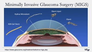 Understanding Glaucoma Diagnosis Treatment and Research on the Horizon [upl. by Ahtinak]