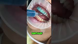 Carillas Vs Brackets dientes dentista tips parati viral fyp shorts shortvideo fypシ [upl. by Madlen651]