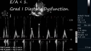 ANTEROSEPTAL AKINESISECHOCARDIOGRAPHY SERIES BY DR ANKUR K CHAUDHARI [upl. by Trebmer]