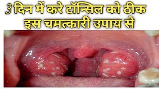 tonsil treatment tonsil ka gharelu upchar [upl. by Doehne883]