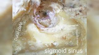 Modified Radical Mastoidectomy [upl. by Fryd890]