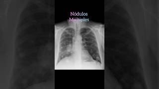 Nódulos pulmonares múltiples chestradiograph radiologiest medicalimaging radiografia viral [upl. by Prisilla60]