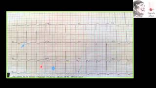 digoxin effect toxicity [upl. by Bridie824]