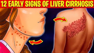 DONT IGNORE 12 Early Signs of Liver CIRRHOSIS  Daily Joy [upl. by Nestor]