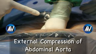 Aortic Compression [upl. by Clair]