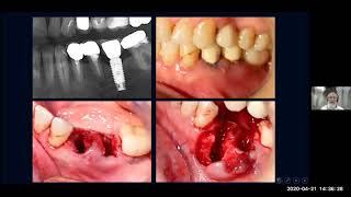 Session 3 recouvrements et cicatrisation  formation Augma Bond Apatite clinique [upl. by Noned]