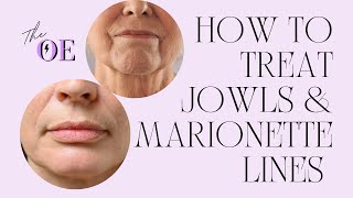 How To Treat Jowls amp Marionette Lines At Home [upl. by Jasper]