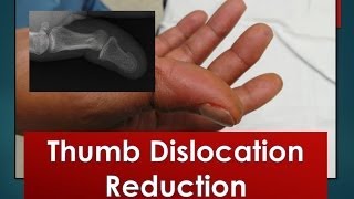 Thumb Dislocation Reduction [upl. by Larina]