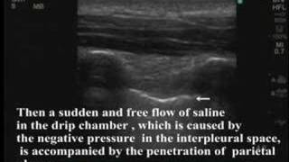 UltrasoundGuided Interpleural Block [upl. by Rivalee147]