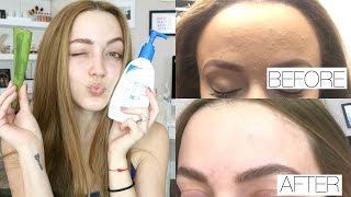 Skin Update  Chit Chat  What Ive Been Using to Help My Skin [upl. by Annawoj227]