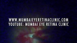 Diabetic vitrectomy  segmentation delamination  Mumbai Eye Retina Clinic [upl. by Adnilec]