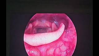 laryngeal papilloma papillomavirus hoarseness cough entsurgeon drbaisalisarkar kolkata [upl. by Adur]