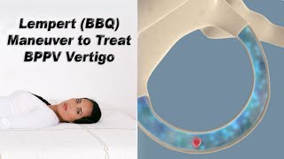 Lempert BBQ Maneuver to Treat BPPV Vertigo [upl. by Pudens503]