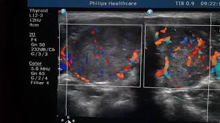 Thyrotoxicosis Sonography [upl. by Dulciana548]