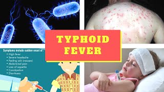 Typhoid Fever Symptoms – Causes Symptoms and Pictures of Enteric fever in Men women [upl. by Mehsah]