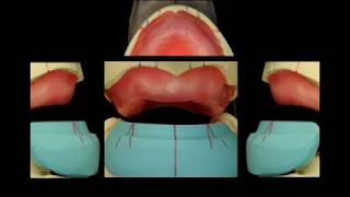 Art of denture 2014 [upl. by Nimar]