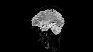 3D isotropic T1 T2 and FLAIR at 15 Tesla in 10 minutes [upl. by Drauode]