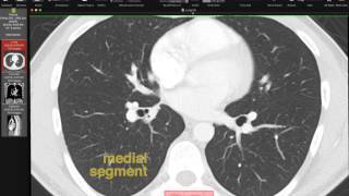 Lobar and Segmental Lung Anatomy on CT [upl. by Bolte]