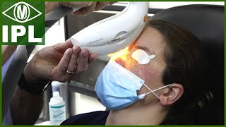 IPL Treatment for Dry Eye Intense Pulsed Light Therapy [upl. by Notlil823]