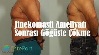 Jinekomasti Ameliyatı Sonrası Çöküntü [upl. by Charie512]