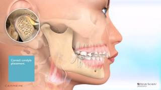 Carriere® Motion™ Appliance for Class II Patient Education Animation [upl. by Areht]