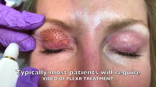 PLEXR PLASMA Eyelid Blepharoplasty [upl. by Norreg]