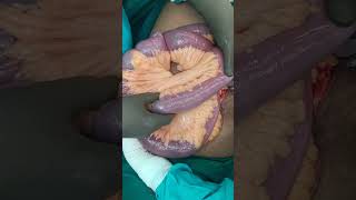 crohn disease  small bowel stricture small bowel resection anatomosis [upl. by Renelle]