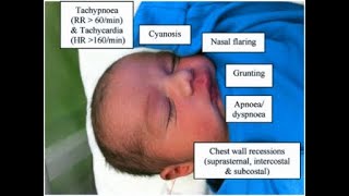 Respiratory distress and respiratory distress syndrome in newbornRDS रेस्पिरेटरी डिस्ट्रेस सिंड्रोम [upl. by Ynetruoc715]