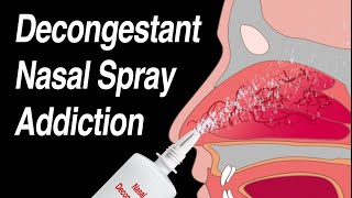 Decongestant Nasal Spray Addiction Afrin Zicam Sinex NeoSynephrine etc [upl. by Hulton613]