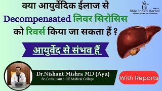 Treatment of Decompensated Liver Cirrhosis With Reports आयुर्वेद है तो संभव हैं [upl. by Ahsytal]