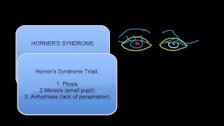 Eye Lid Ptosis [upl. by Sontag]