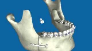 Retroceso de Mandíbula por Prognatismo Mandibular [upl. by Eendys]