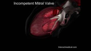 Mitral Valve normal and incompetent [upl. by Ellezig]