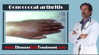 Gonococcal arthritis  Causes Diagnosis Symptoms Treatment Prognosis [upl. by Aryaz]