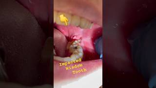 Impacted Wisdom Tooth should be removed [upl. by Drolyag]