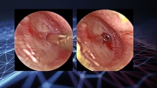 Endoscopic myringotomy and ventilation tube placement in glue ear [upl. by Castara17]