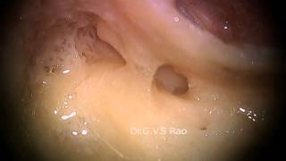 FULL HD  Hands on cadaver Temporal bone dissection Part 2 [upl. by Sage]