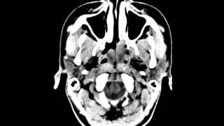 Nasal Polyposis [upl. by Klusek]