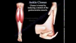 Ankle Clonus  Everything You Need To Know  Dr Nabil Ebraheim [upl. by Etem]