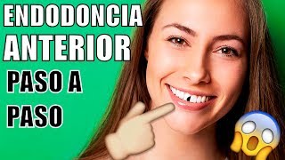 ENDODONCIA EN EL DIENTE DELANTERO ME ROMPÍ UN DIENTE COMO ES UNA ENDODONCIA COMO MTAR EL NERVIO [upl. by Cloe]