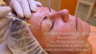 Mesotherapie mit Hyaluronsäure  Behandlung Vorher Nachher [upl. by Butch]