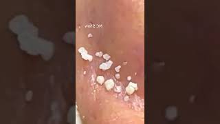 Pickel Ausdrücken Blackheads Akne amp Mitesser entfernen 🔴 28 [upl. by Arateehc]