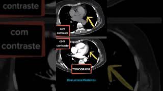 TOMOGRAFIA  Com contraste e sem contraste [upl. by Gimpel]