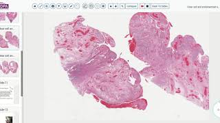 Digital Pathology sign out 27 1 Clear cell carcinoma of the ovary [upl. by Maggie]