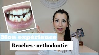 Mon expérience avec lorthodontie  Broches pour adulte [upl. by Tomlinson688]