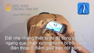 Thước đo cong vẹo cột sống  CÁCH SỬ DỤNG [upl. by Ynohtnaed154]